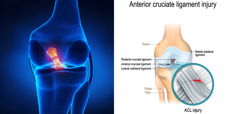 Image showing what an ACL tear looks like